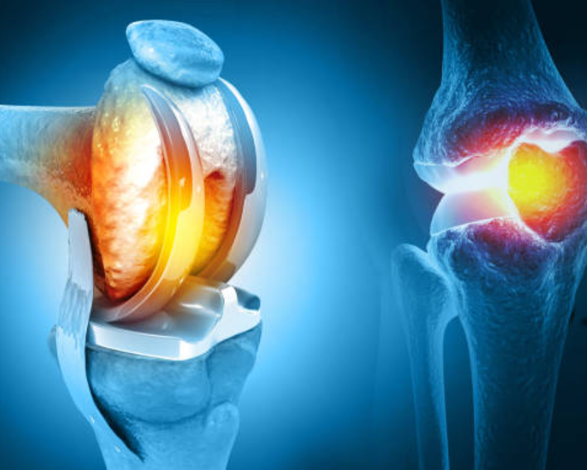 Joint Replacement Surgery